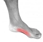 Bekijk de oplossingen tegen platvoeten (pijn a.d. binnenzijde),  doorgezakte voeten (overpronatie)